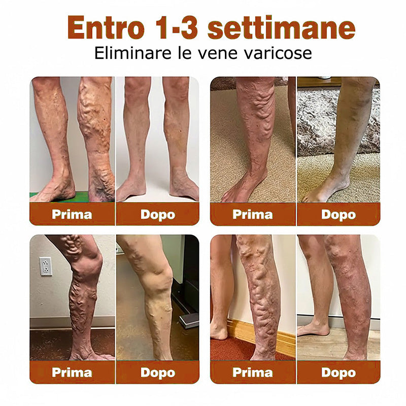 🇮🇹🔥🔥Zvoevo® Cerotto con Microaghi Rilassante Venoso⚡Sollievo immediato, risultati a lungo termine