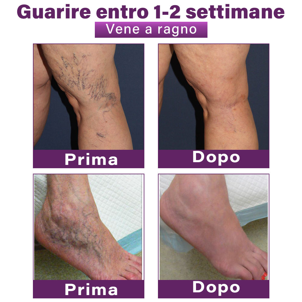 ✅ GFOUK® Cerotto Nano Varicose con Polidocanolo 👩🏼‍⚕️ Per Varici, Vene Varicose e Gonfiore alle Gambe