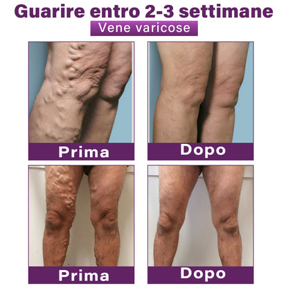 ✅ GFOUK® Cerotto Nano Varicose con Polidocanolo 👩🏼‍⚕️ Per Varici, Vene Varicose e Gonfiore alle Gambe