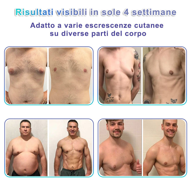 GFOUK® NanoMedix Patch Ginecomastia - Azione Brucia Grassi e Tonificante