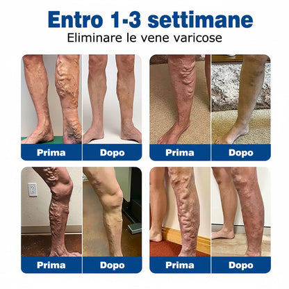 🇮🇹👨‍⚕️💝GFOUK® VeinTarget Microneedle Patch⚡Sollievo immediato, risultati a lungo termine