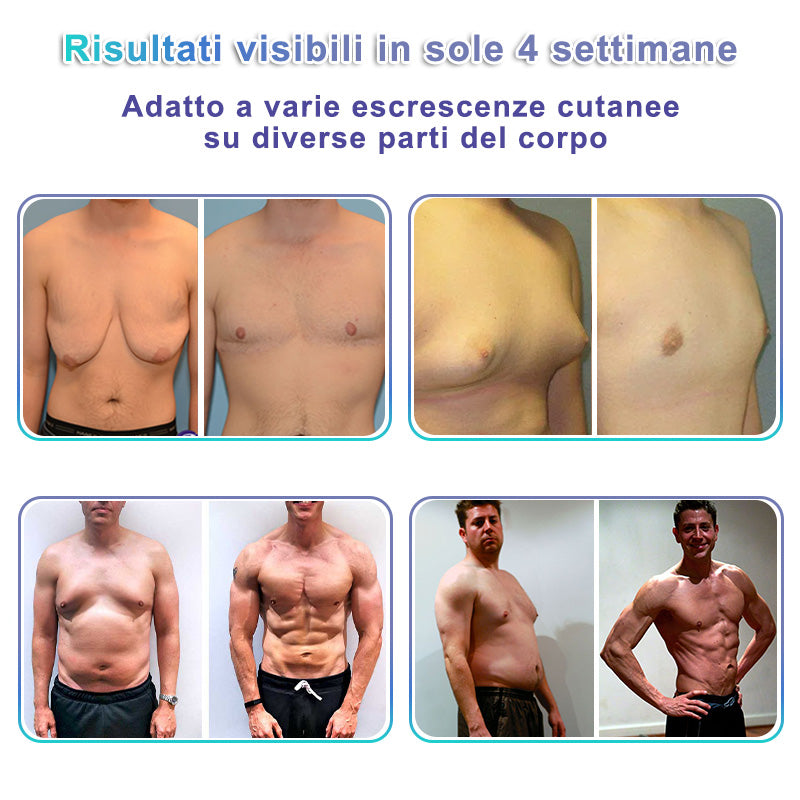 GFOUK® NanoMedix Patch Ginecomastia - Azione Brucia Grassi e Tonificante