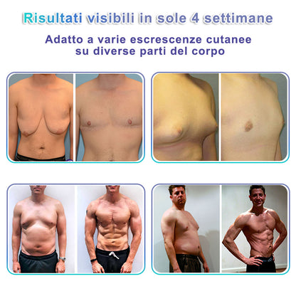 GFOUK® NanoMedix Patch Ginecomastia - Azione Brucia Grassi e Tonificante