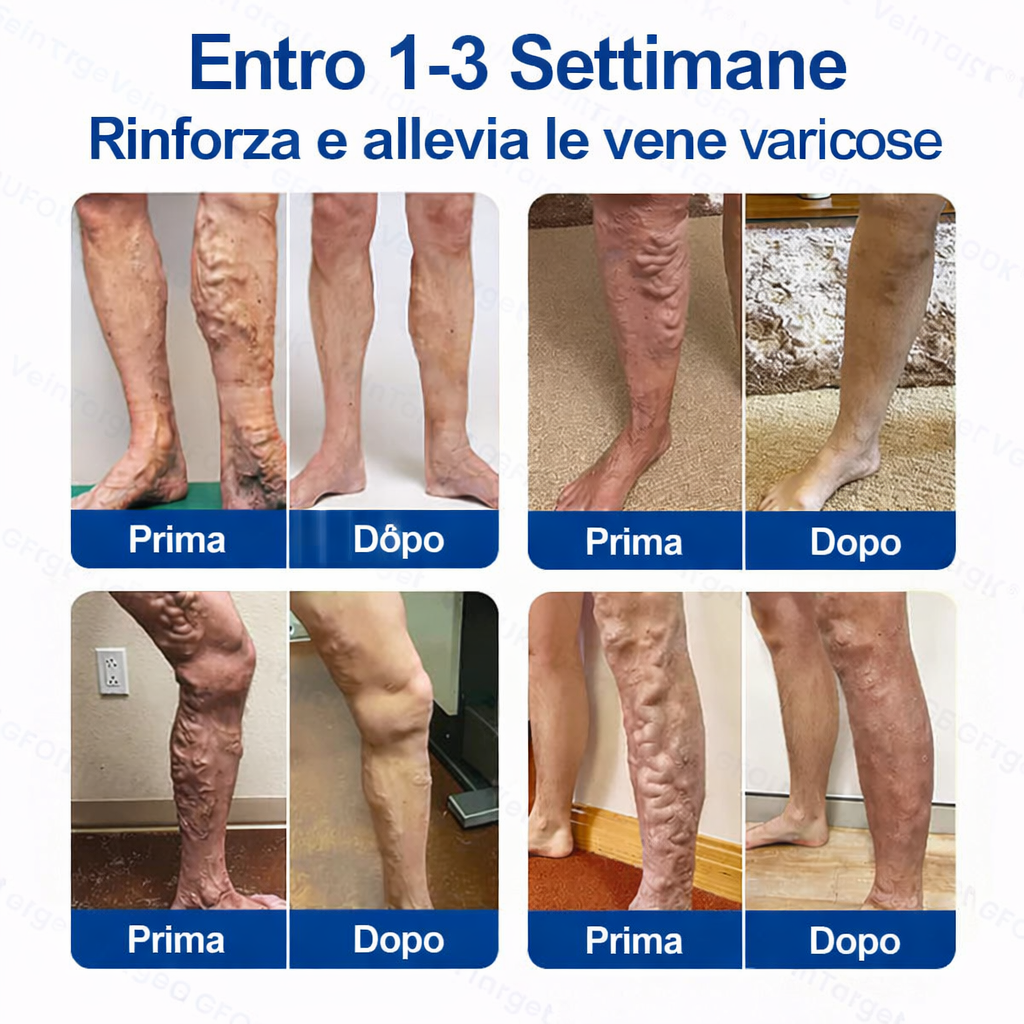 🇮🇹🔥🏂🏿GFOUK® Cerotto con Microaghi Rilassante Venoso⚡Sollievo immediato, risultati a lungo termine