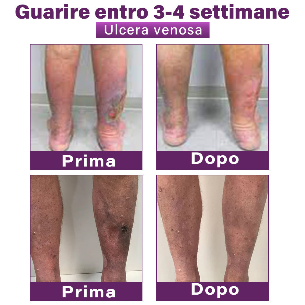 ✅ GFOUK® Cerotto Nano Varicose con Polidocanolo 👩🏼‍⚕️ Per Varici, Vene Varicose e Gonfiore alle Gambe