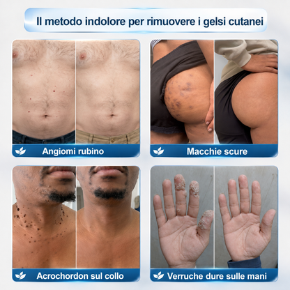 Negozio ufficiale del marchio | (QZBSYZUPSELL)Remifa ® Rimuovi macchie ed escrescenze cutanee in 7 giorni (roller indolore, senza cicatrici dopo l'uso)
