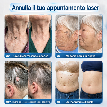 Negozio ufficiale del marchio | (QZBSYZUPSELL)Remifa ® Rimuovi macchie ed escrescenze cutanee in 7 giorni (roller indolore, senza cicatrici dopo l'uso)